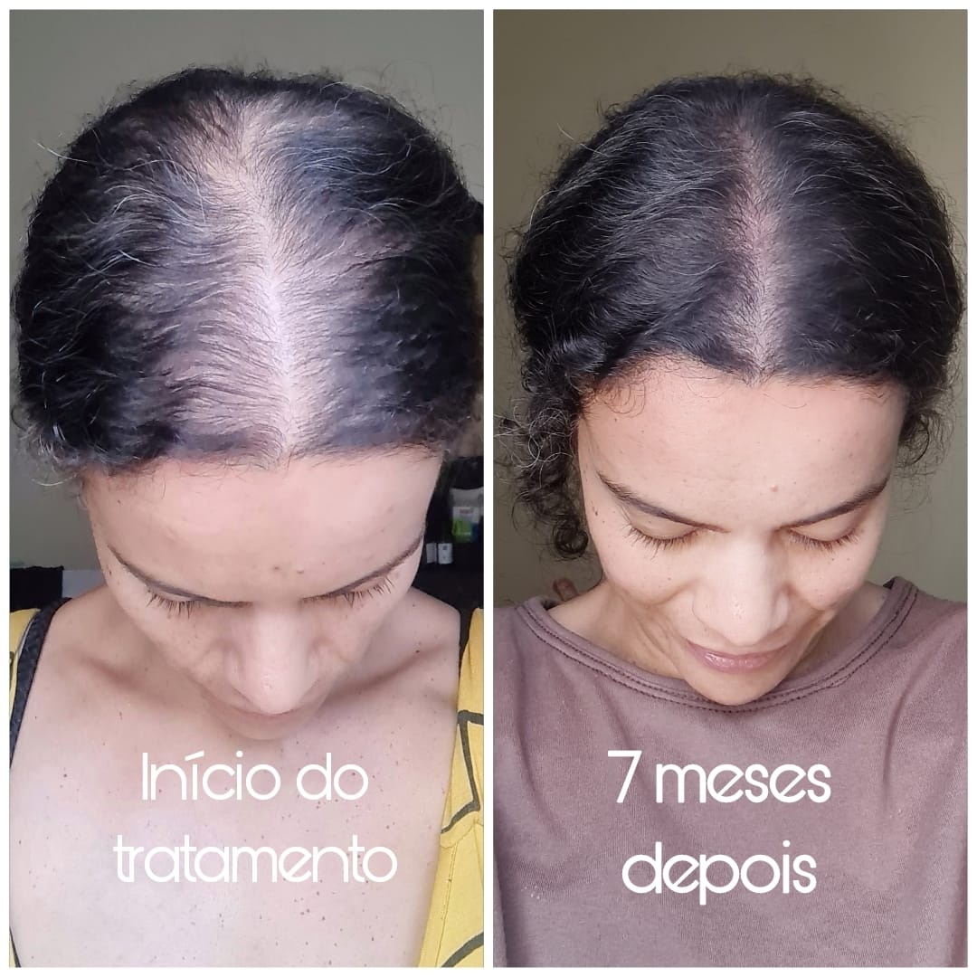 Comparação do topo da cabeça de Kariny no início do tratamento e sete meses depois
