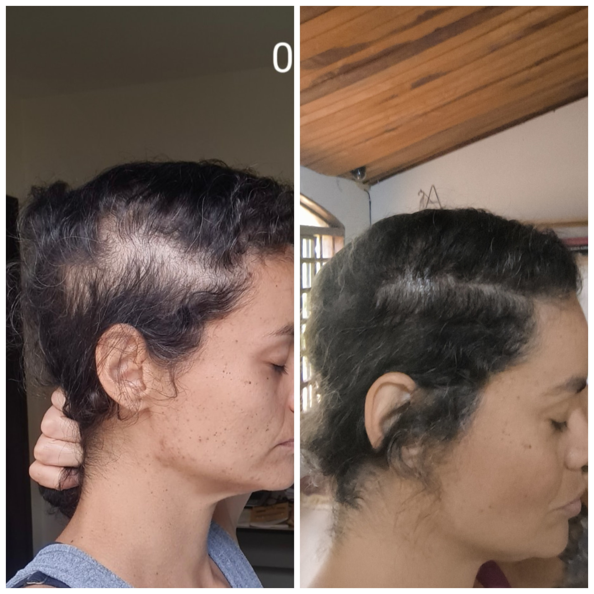 Comparação lateral do couro cabeludo de Kariny antes e depois do tratamento